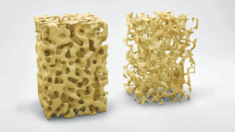Osteoporosis