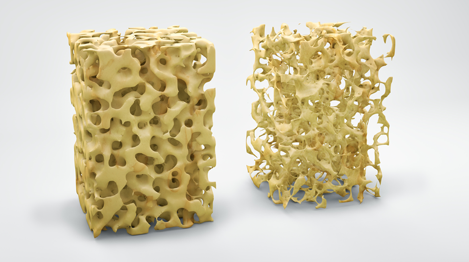 La osteoporosis, una enfermedad silenciosa