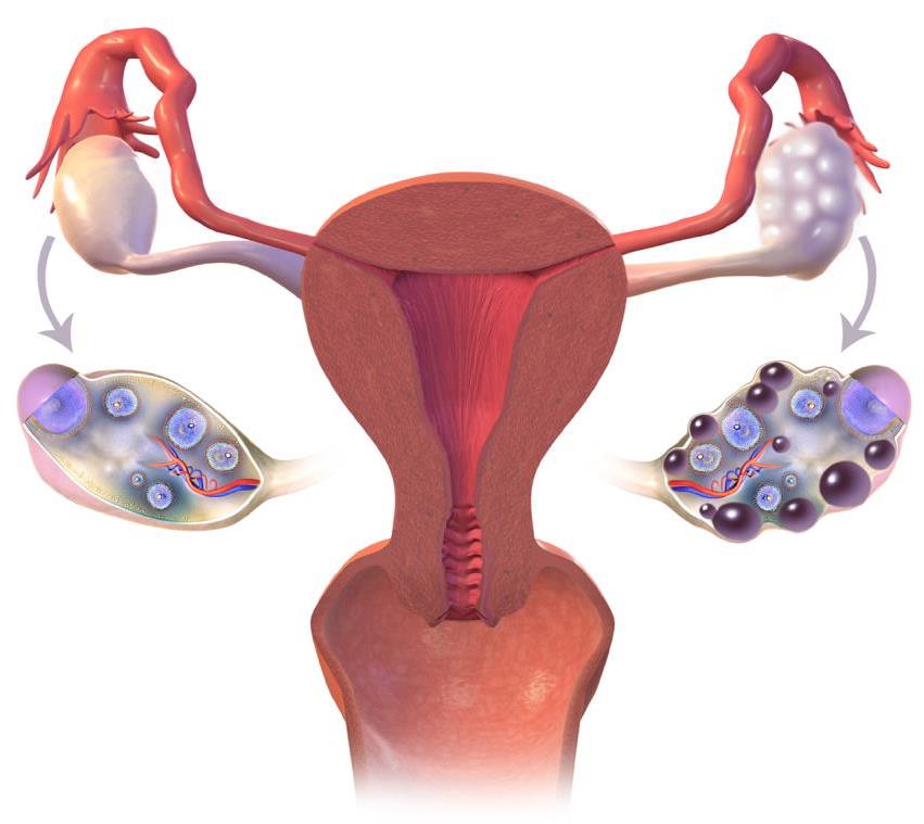 ¿Qué es el síndrome de ovario poliquístico y por qué ocurre?