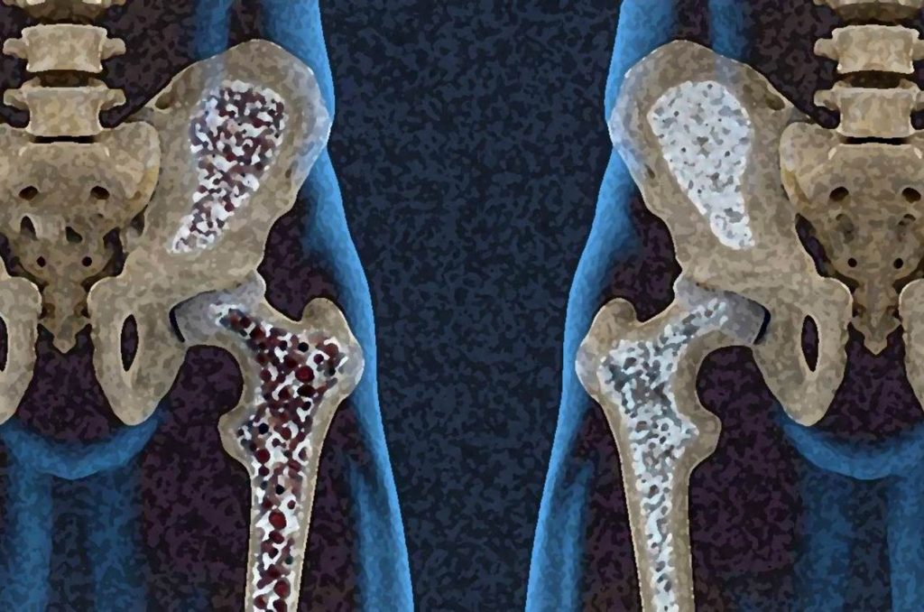 Osteoporosis masculina. ¿Cómo se relacionan los huesos con el pene?
