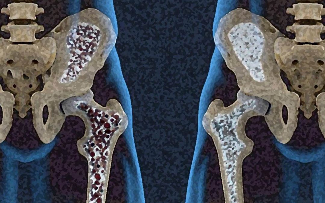 Osteoporosis masculina. ¿Cómo se relacionan los huesos con el pene?