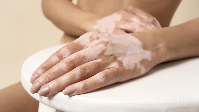 ¿Cómo la vitamina D puede apoyar el tratamiento del vitiligo?