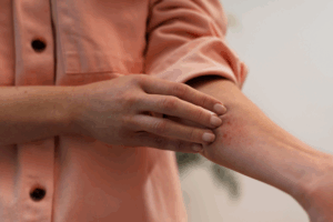 dermatitis atópica