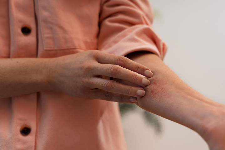 dermatitis atópica